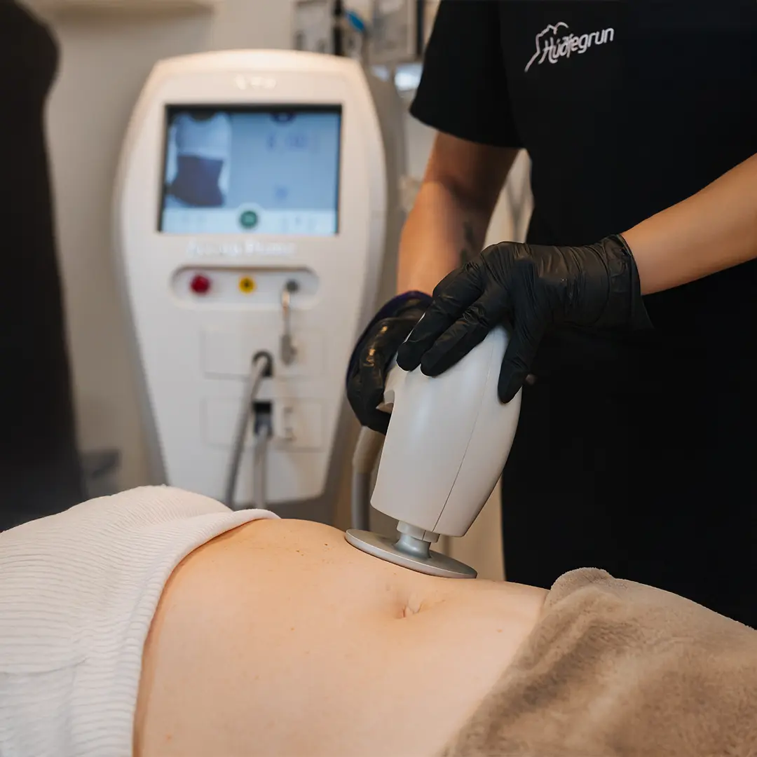 Fitueyðing með ultrasound tækni sem eyðir fitu á öruggan og sársaukalausan hátt með nýjustu tækni frá Húðfegrun.