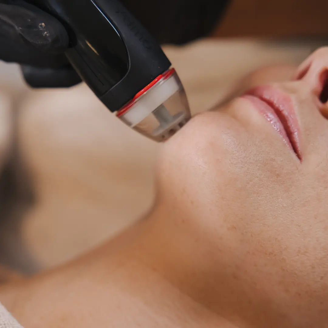 Öfg­nærmynd af Dermaclear-meðferð á húð í hakasvæði þar sem tæknin vinnur djúpt í húðinni til að hreinsa, endurnýja og bæta áferð húðar á öruggan og nákvæman hátt.