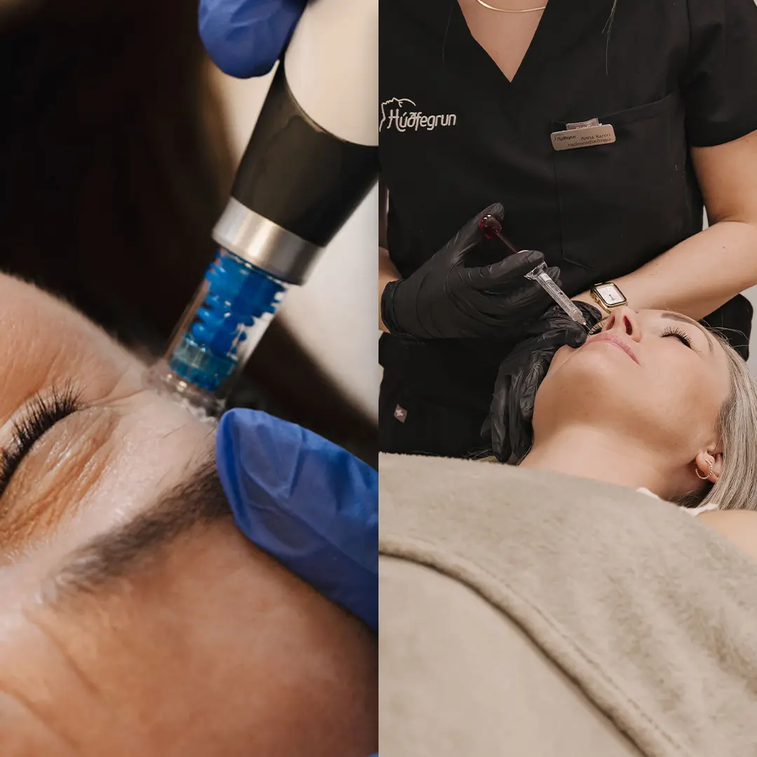 DermaBooster meðferð framkvæmd í björtum og faglegum aðstæðum í miðbæ Reykjavíkur. Myndin sýnir annars vegar Dermapen örnálameðferð (microneedling) sem örvar kollagenframleiðslu og eykur endurnýjun húðar, og hins vegar nákvæma innspýtingu með hyaluronic sýru framkvæmd af löggiltum hjúkrunarfræðingi. Meðferðin sameinar djúpan raka, aukna teygjanleika og sýnilega bætingu á áferð húðar með öruggum og faglegum vinnubrögðum.