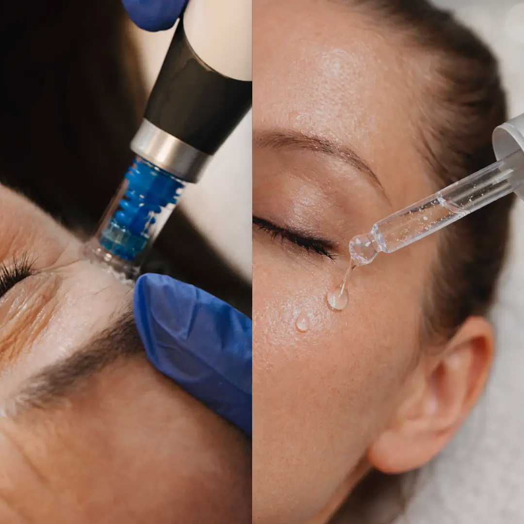 Nærmynd af Dermapen microneedling meðferð sem örvar kollagenframleiðslu og dregur úr fínum línum, framkvæmd af hjúkrunarfræðingi á Húðfegrun.