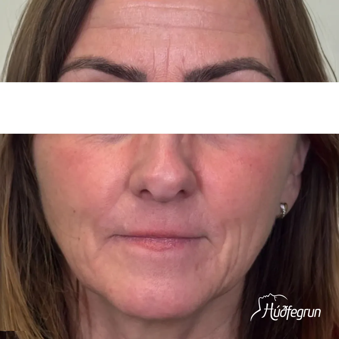 Samanburður fyrir og eftir Laserlyftingu sýnir markverðan árangur á hálsi og neðra andliti. Þéttari og stinnari húð með nýjustu tækni – bókaðu meðferð á Húðfegrun í Reykjavík.