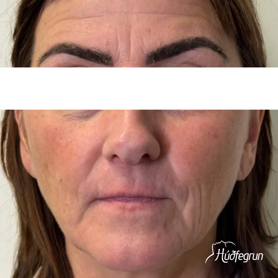 Samanburður fyrir og eftir Laserlyftingu sýnir markverðan árangur á hálsi og neðra andliti. Þéttari og stinnari húð með nýjustu tækni – bókaðu meðferð á Húðfegrun í Reykjavík.