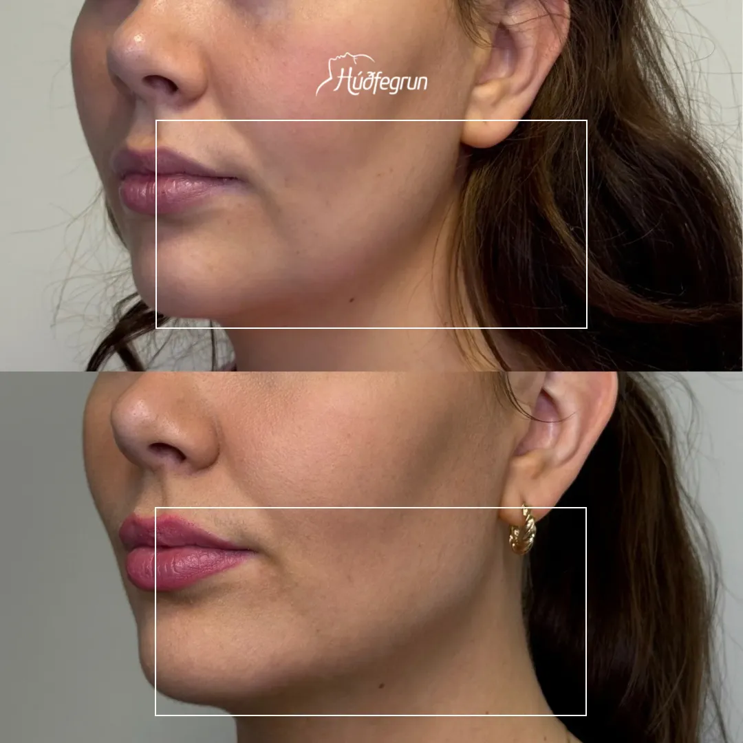 Fyrir og eftir fylliefnameðferð á kjálkalínu og neðra andlit – bætt skilgreining og þéttari húð með náttúrulegri niðurstöðu
