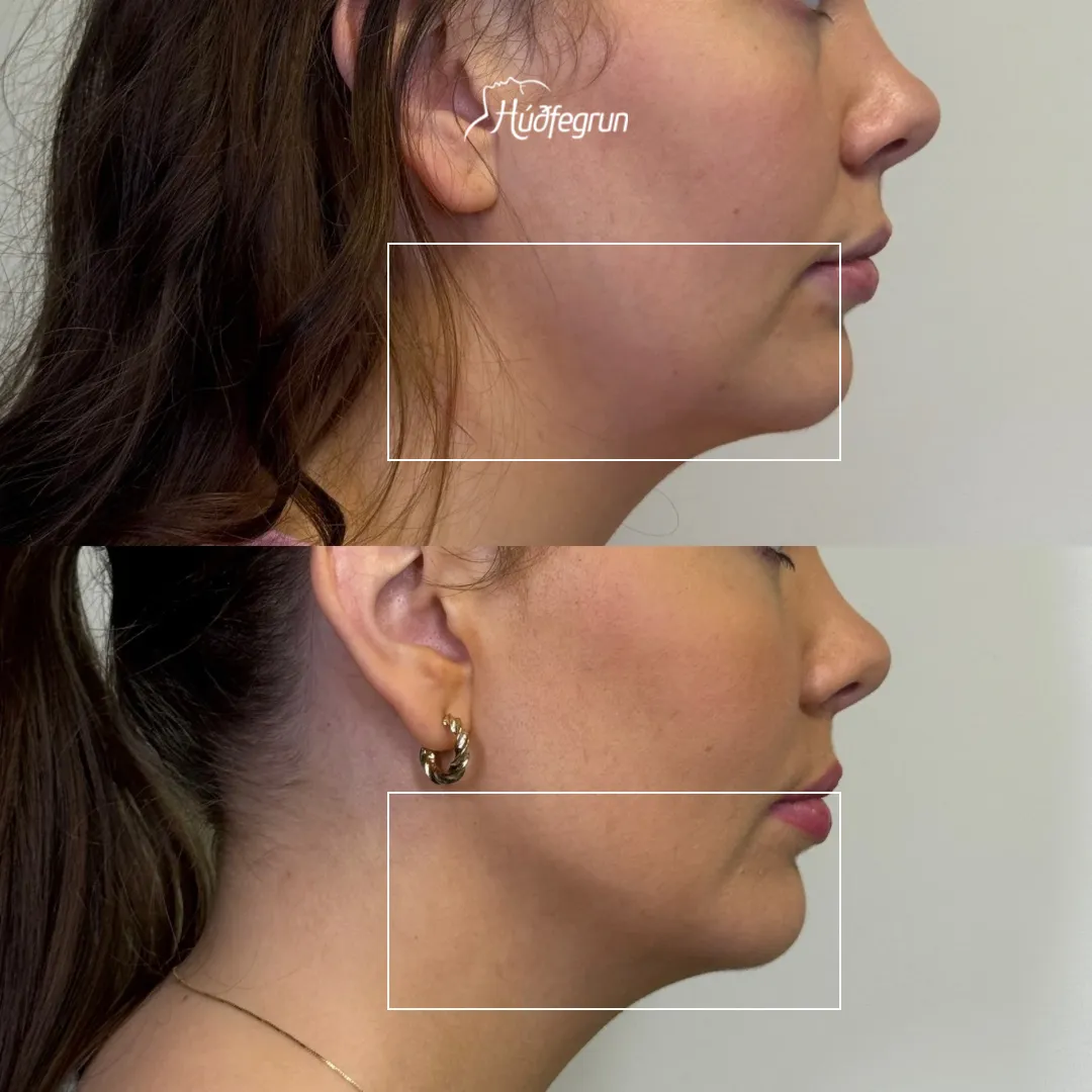 Fyrir og eftir gelisprautun í kjálkalínu og höku – skýrari útlínur og betur mótuð andlitslína hjá konu