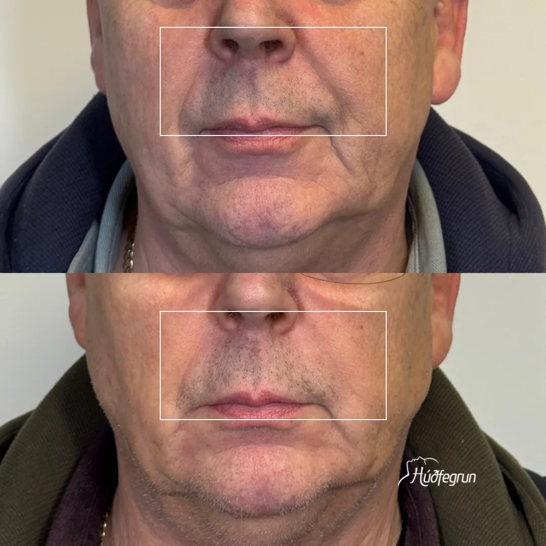 Fyrir og eftir gelisprautun (fylliefni) á nasolabial línur og svæðið í kringum munn – sýnileg minnkun á hrukkum og bætt áferð húðar hjá karli