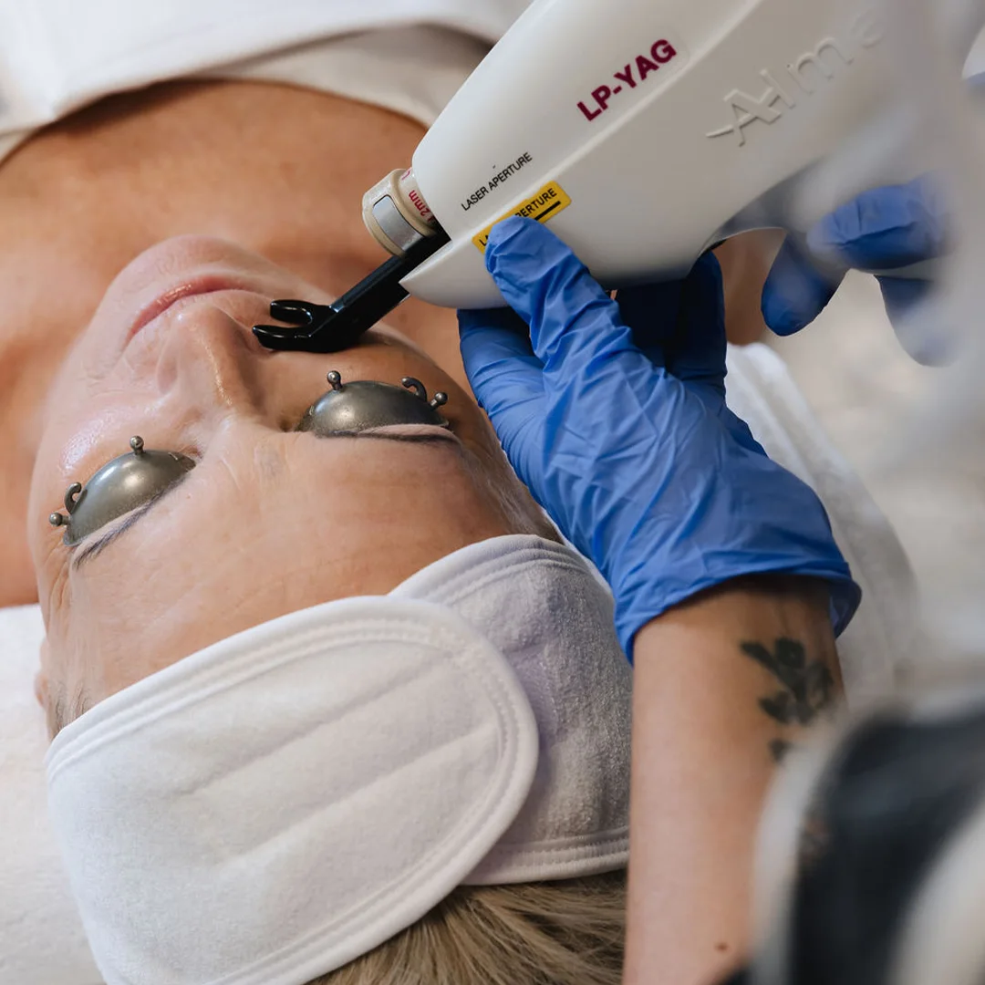 LP-YAG laser frá Alma Lasers notaður hjá Húðfegrun til meðferðar á djúpum háræðaslitum í andliti og á fótleggjum.