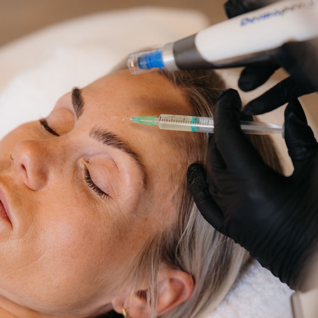 DermaBooster meðferð framkvæmd í björtum og faglegum aðstæðum í miðbæ Reykjavíkur. Myndin sýnir annars vegar Dermapen örnálameðferð (microneedling) sem örvar kollagenframleiðslu og eykur endurnýjun húðar, og hins vegar nákvæma innspýtingu með hyaluronic sýru framkvæmd af löggiltum hjúkrunarfræðingi. Meðferðin sameinar djúpan raka, aukna teygjanleika og sýnilega bætingu á áferð húðar með öruggum og faglegum vinnubrögðum.