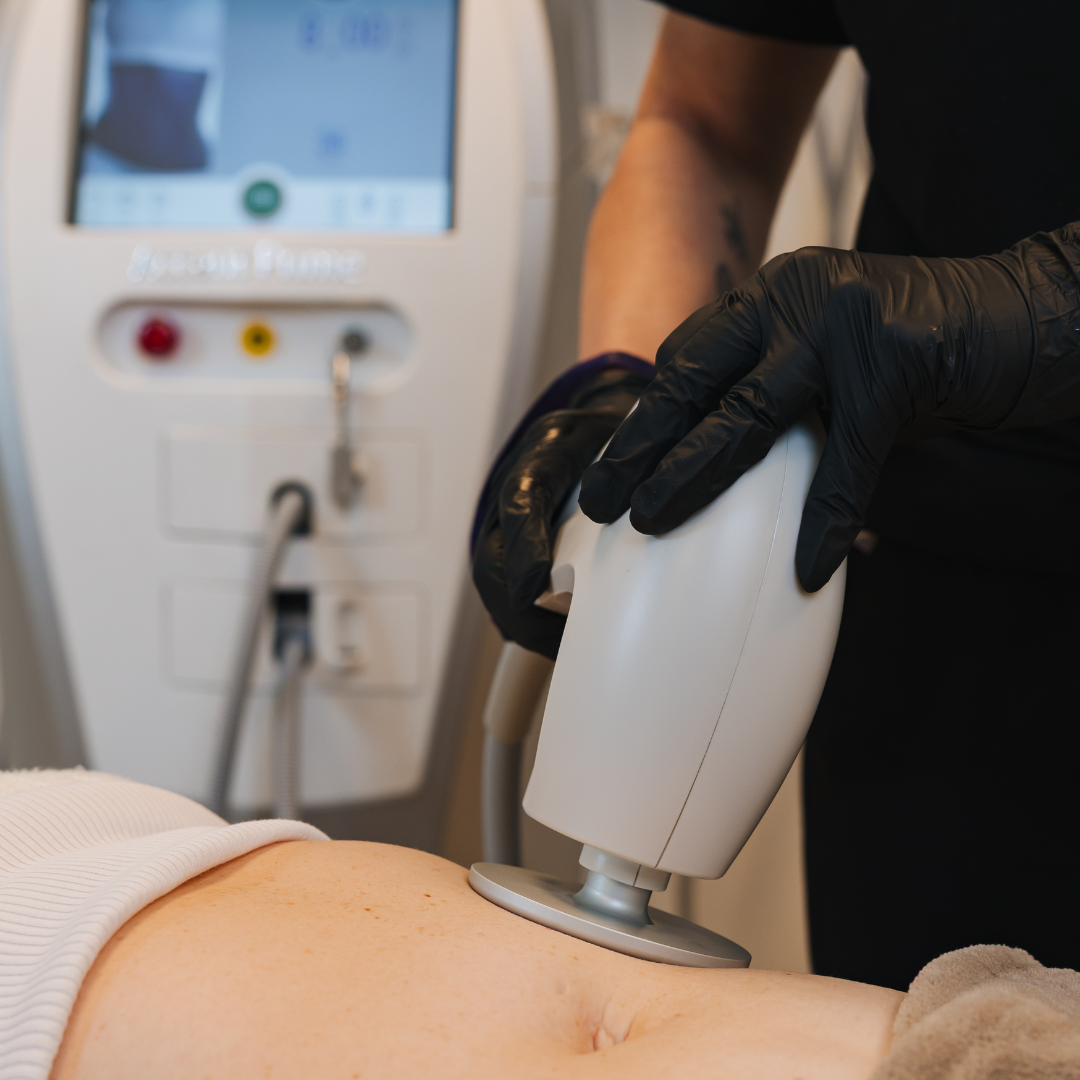 Sjúkraliði á Hudfegrun framkvæmir fitueyðandi ómskoðunarmeðferð (ultrasound fat reduction) á kvið skjólstæðings í björtum og nútímalegum aðstöðu stofunnar. Meðferðin notar nýjustu tækni til að brjóta niður fitu í fitufrumum, sem umbreytist í vatn og skiljast náttúrulega úr líkamanum. Skjólstæðingurinn liggur afslappaður á meðferðarbekk á meðan tækið er dregið markvisst yfir meðferðarsvæðið. Hudfegrun mælir með fjórum til sex meðferðum til að ná sem bestum og varanlegum árangri í líkamsmótun.