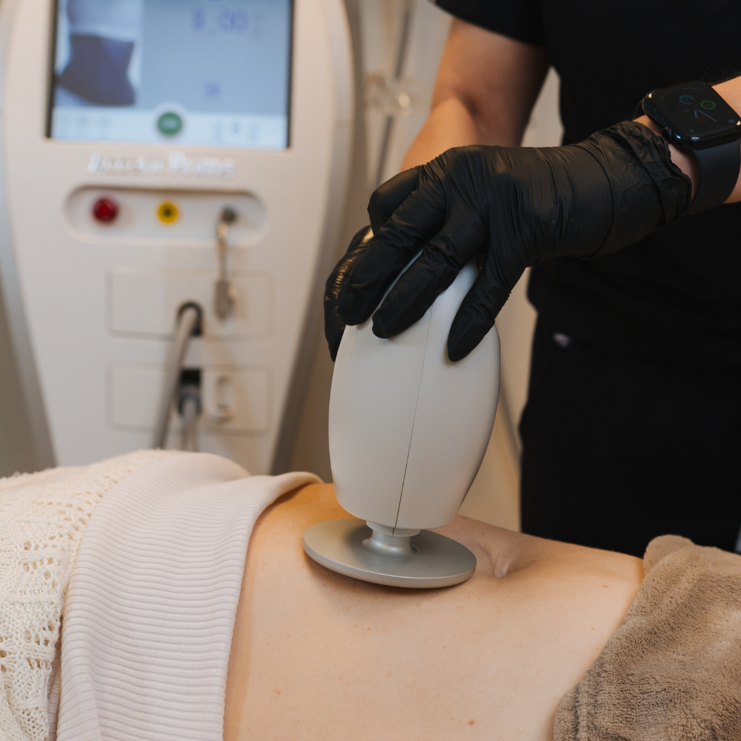 Sérfræðingur hjá Húðfegrun undirbýr Fitueyðingu Ultrasound fyrir líkamsmótun og fitusöfnun