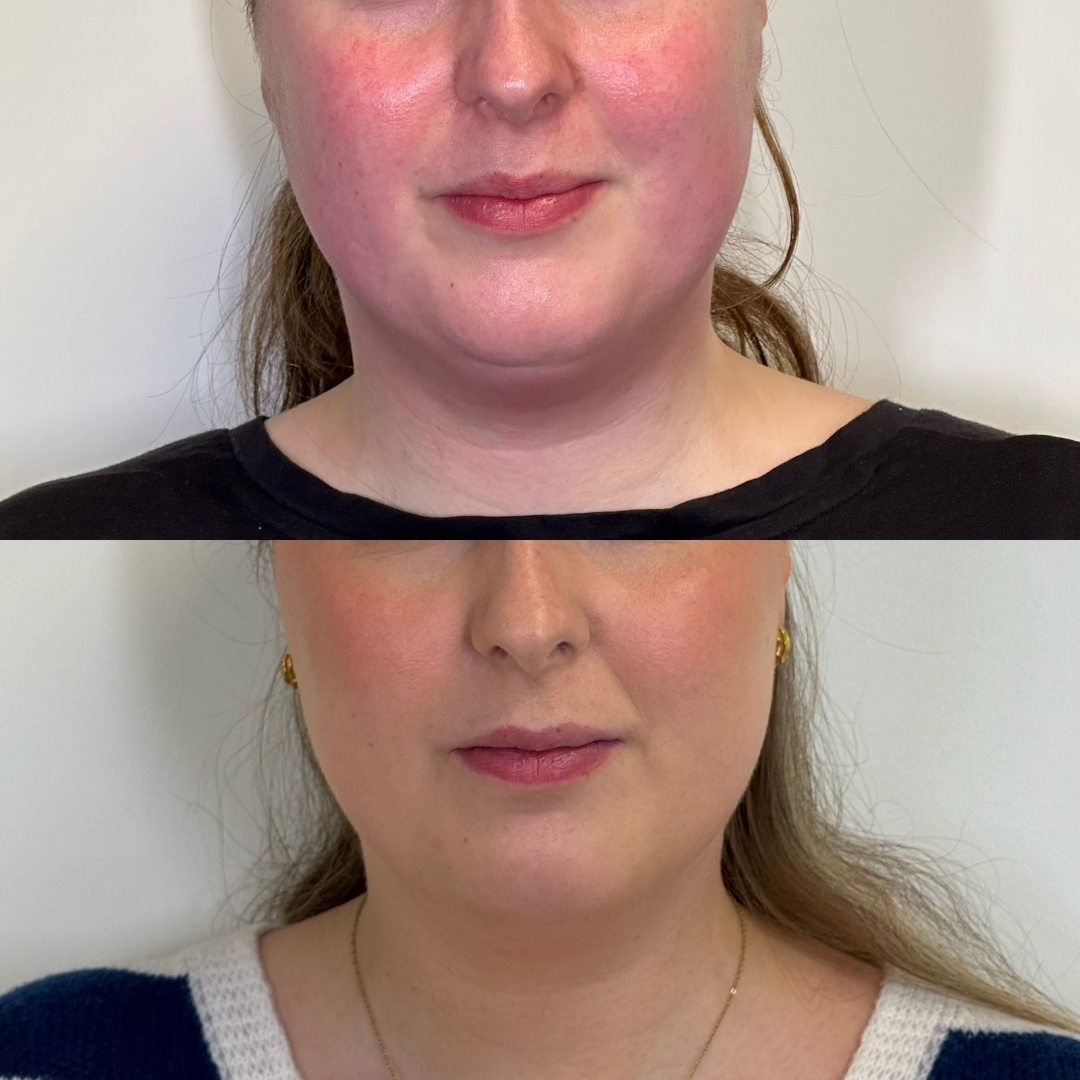 Mynd sýnir maga og mitti fyrir og eftir fitueyðingu hjá Húðfegrun. Áberandi minnkun á fitu og sléttari húð eftir meðferð með nýjustu Ultrasound tækni. Bókaðu faglega líkamsmótun á húðklíníku í Reykjavík.
