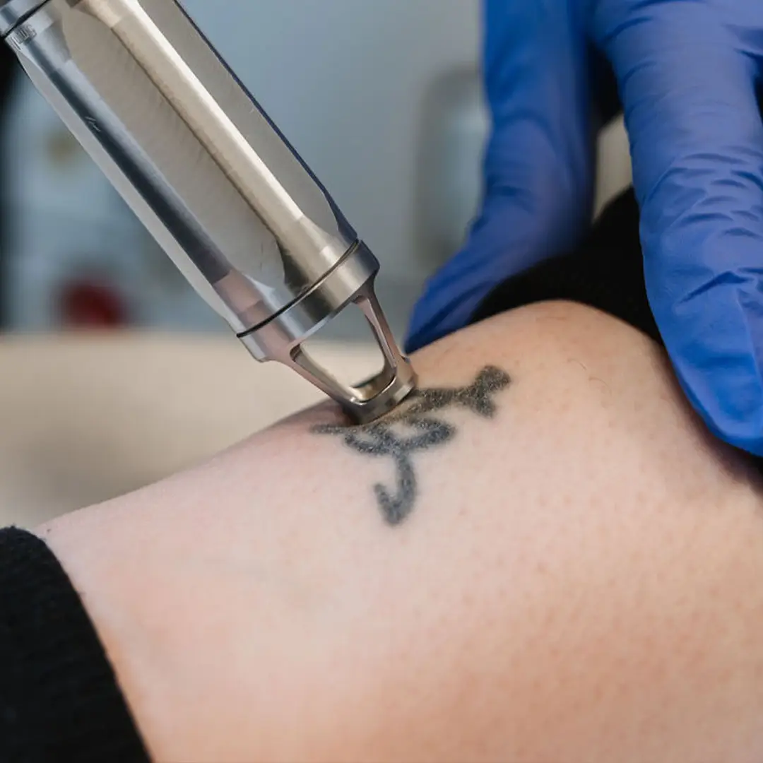 Hjúkrunarfræðingur framkvæmir augnlyftingu á húðklíníku Húðfegrunar í Reykjavík til að lyfta augnlokum og þétta húð á augnsvæði á náttúrulegan hátt.