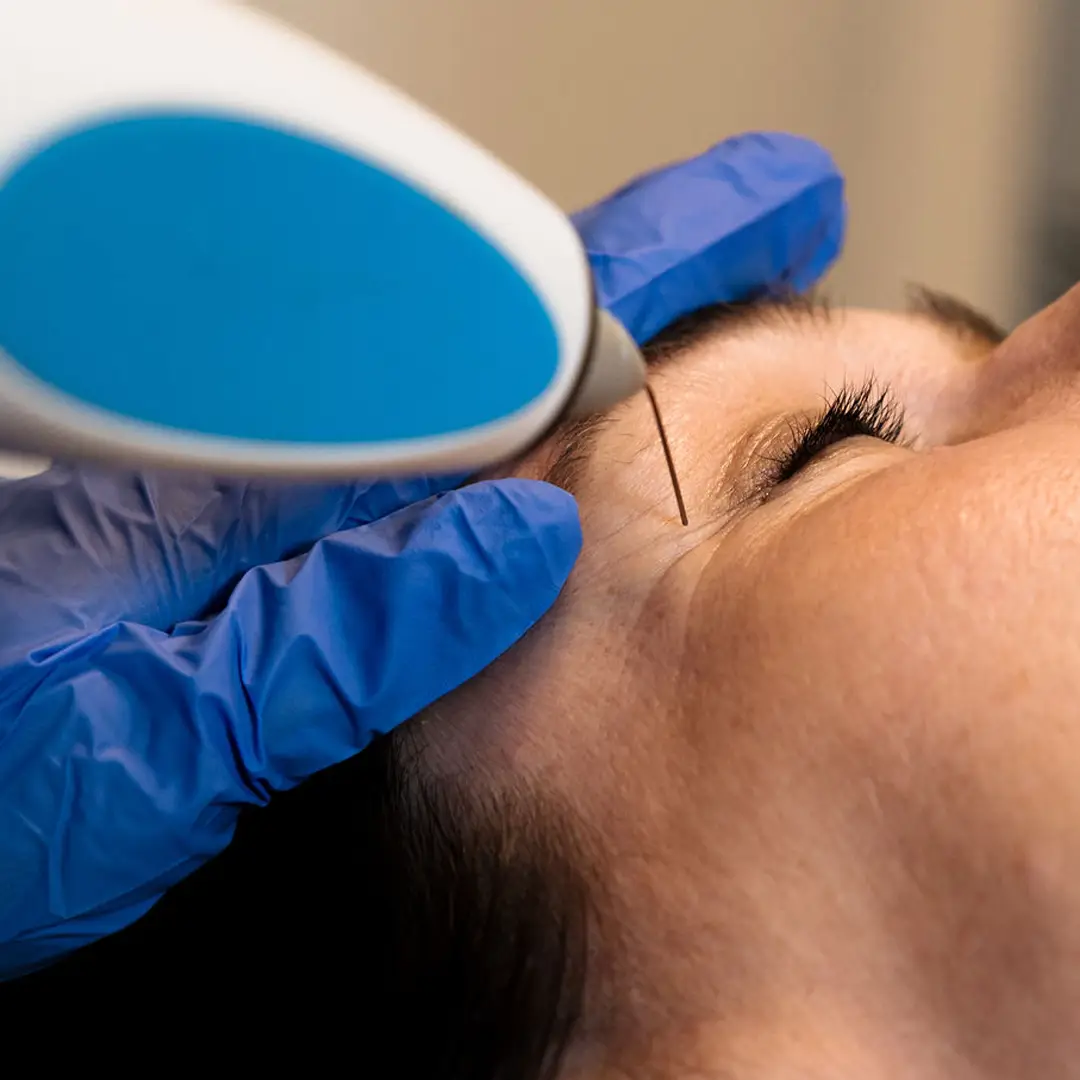 Hjúkrunarfræðingur framkvæmir augnlyftingu á húðklíníku Húðfegrunar í Reykjavík til að lyfta augnlokum og þétta húð á augnsvæði á náttúrulegan hátt.