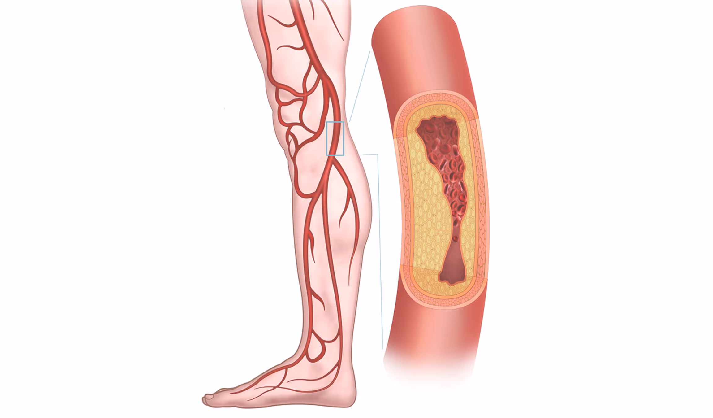 Illustration of a human leg highlighting the arterial blood vessels with a magnified cross-section showing plaque buildup inside an artery.