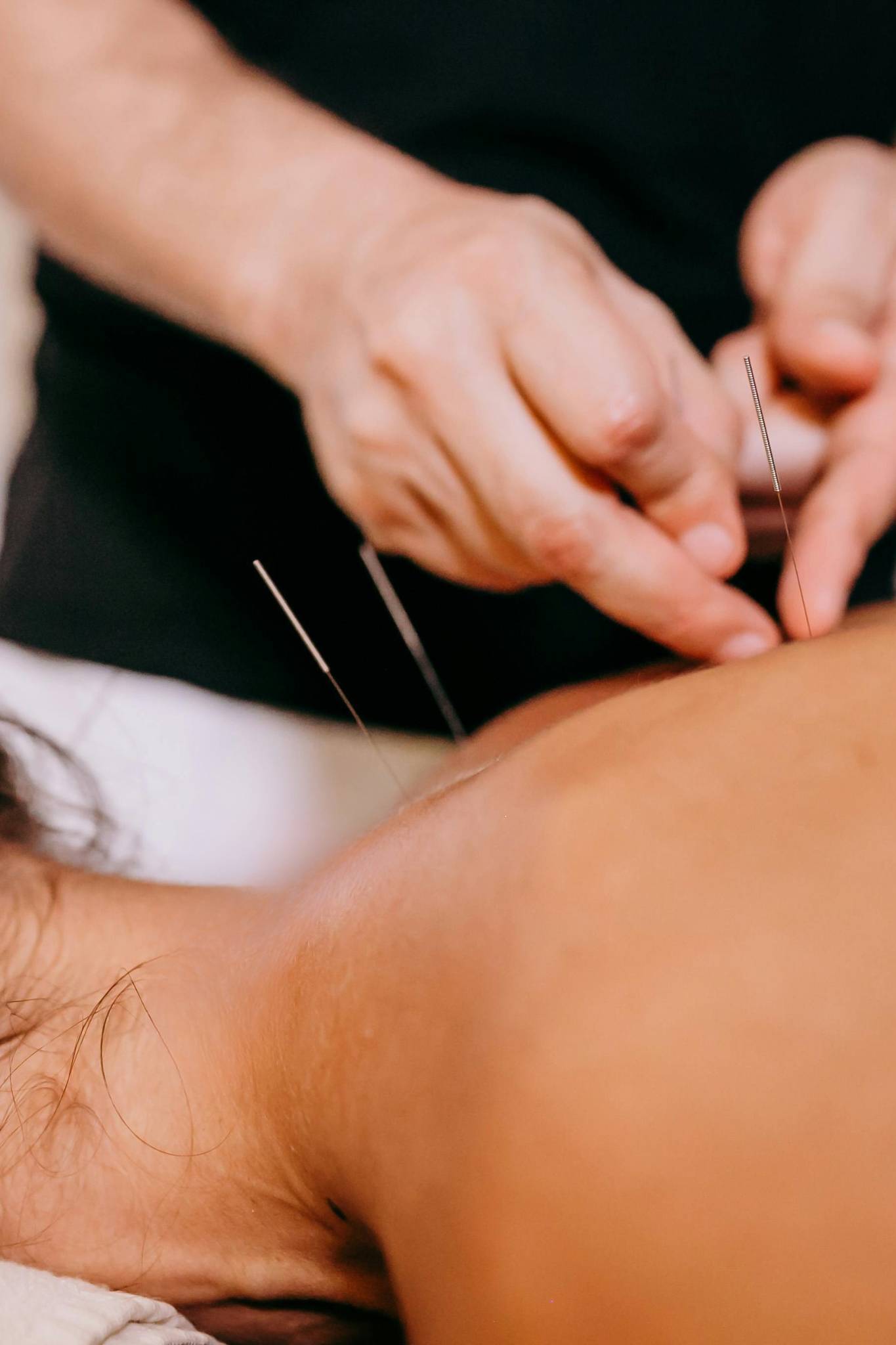 Dry needling treatment