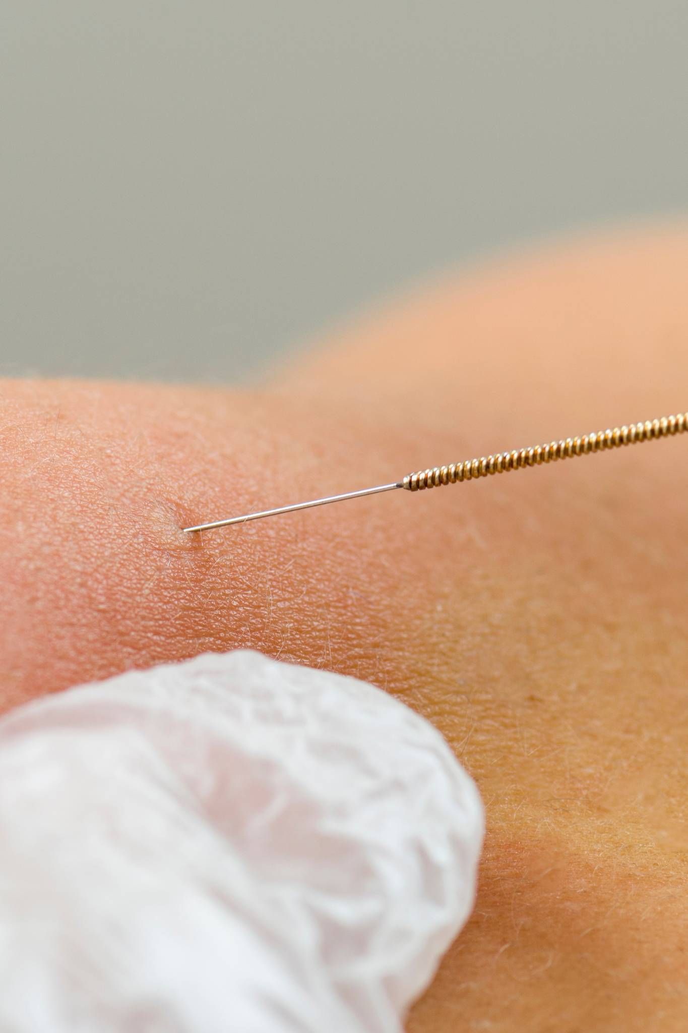 Dry needling 