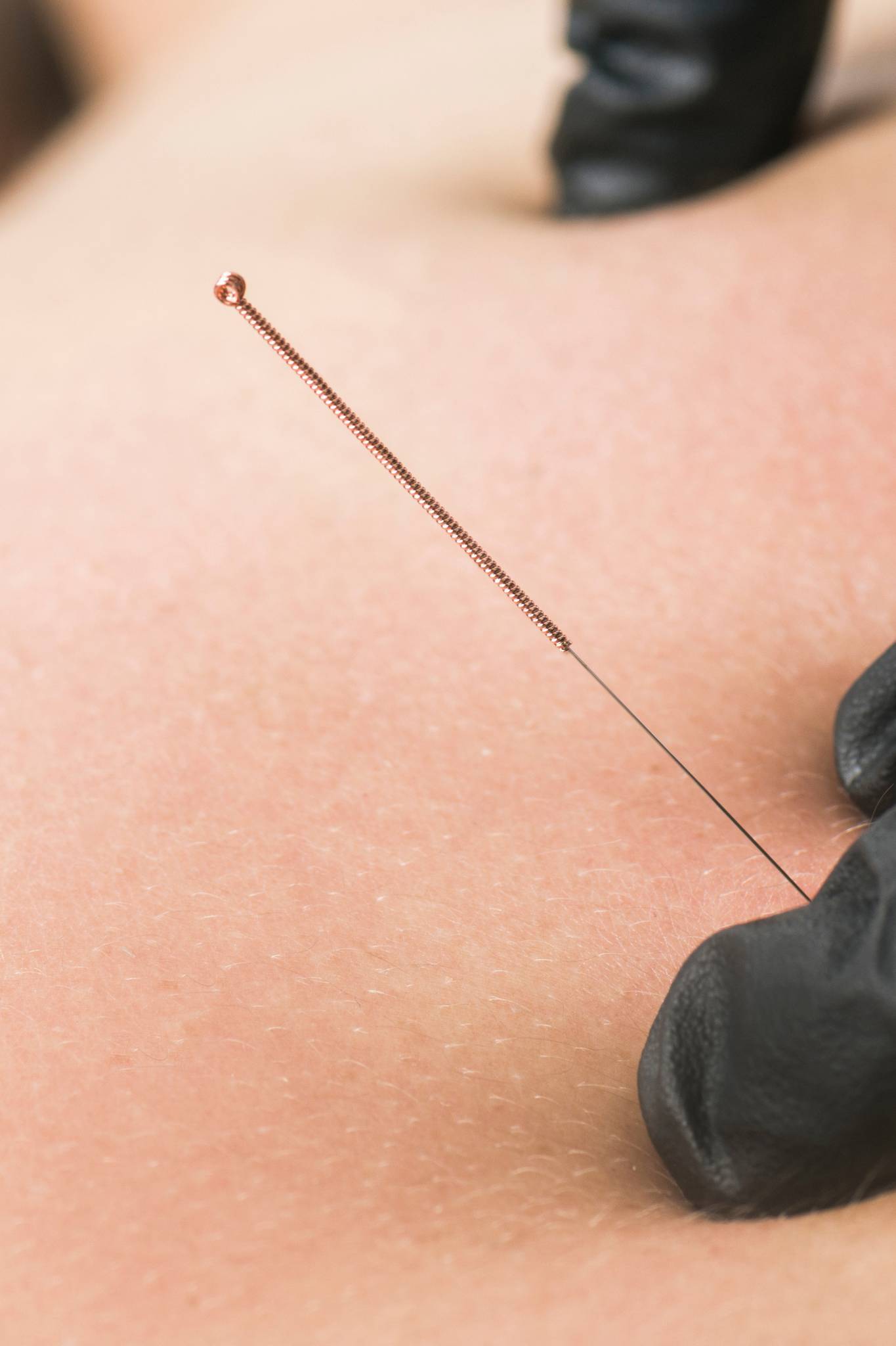 Dry needling