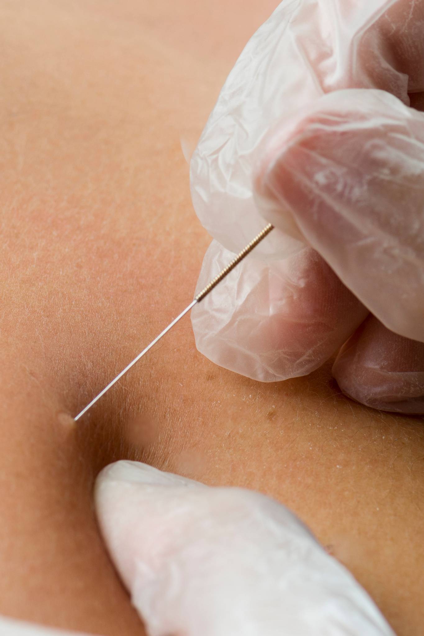 dry needling