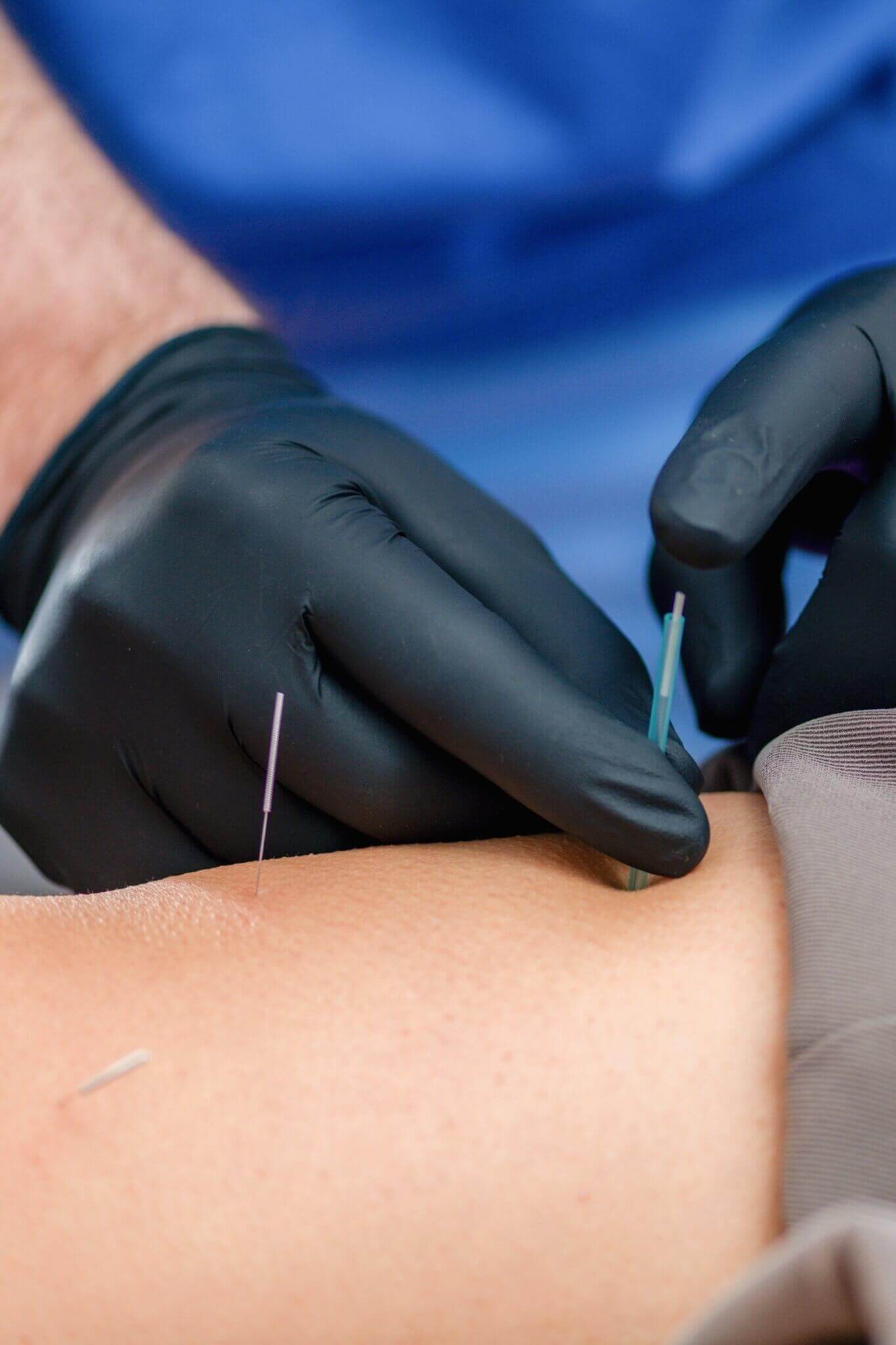 Dry needling treatment