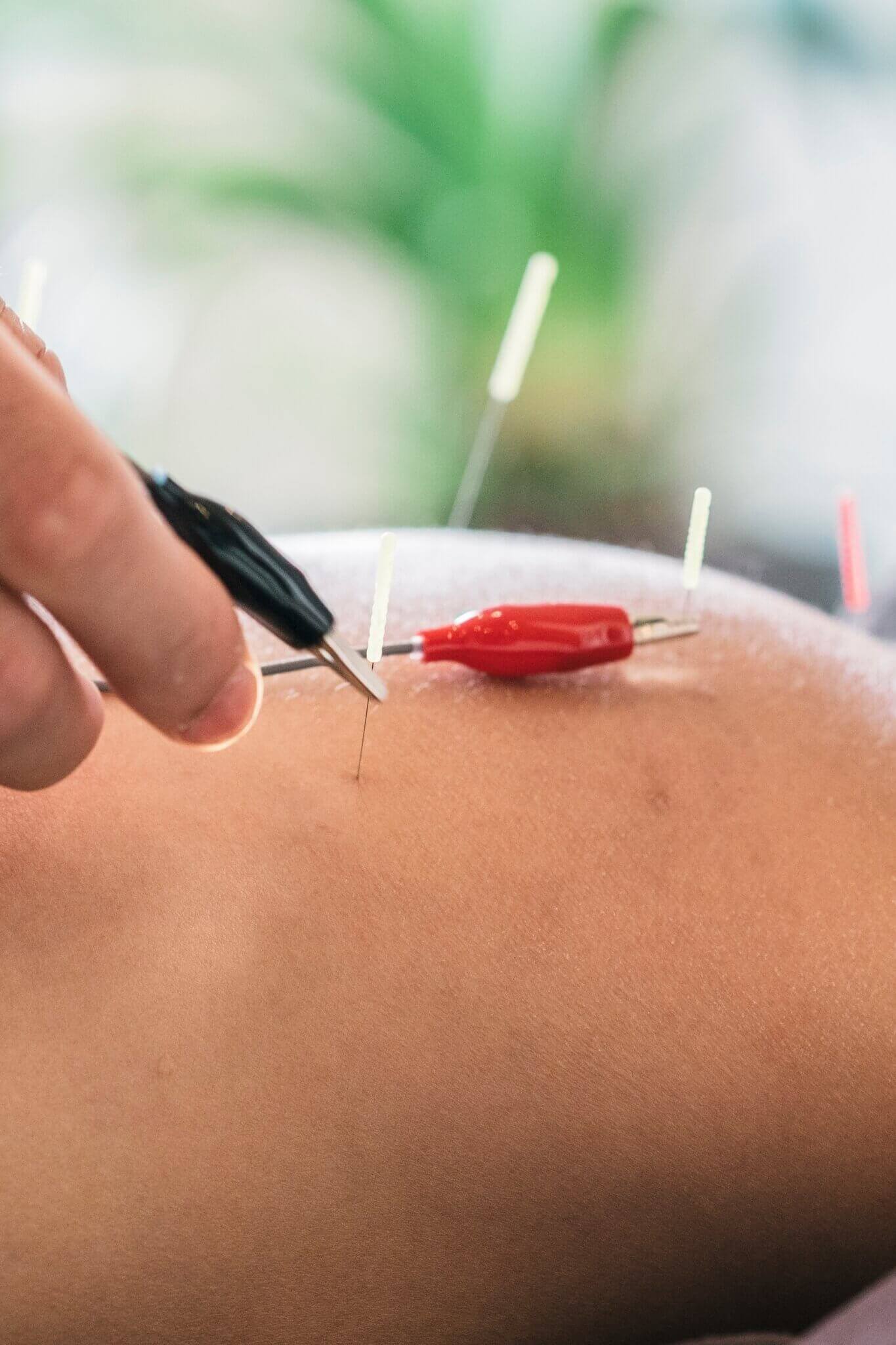 Dry needling