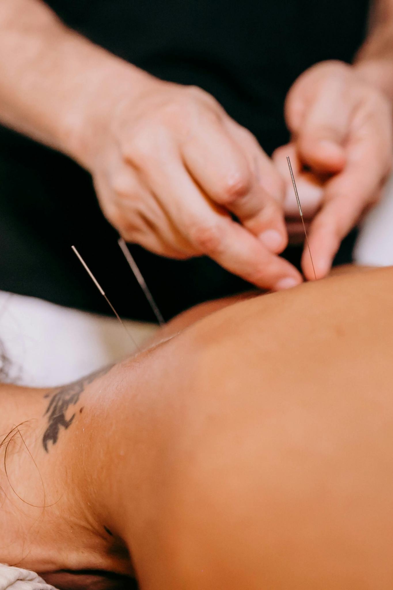 Dry needling treatment
