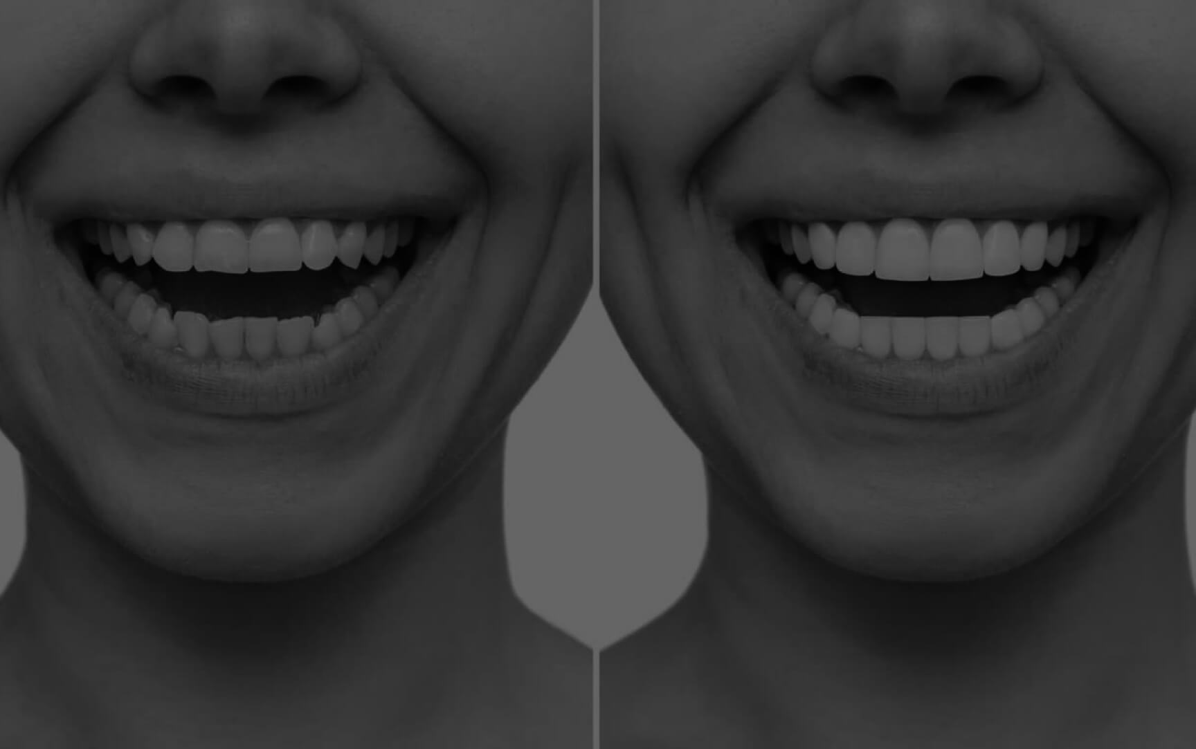 Side-by-side before and after smile showing teeth alignment and whitening improvement.