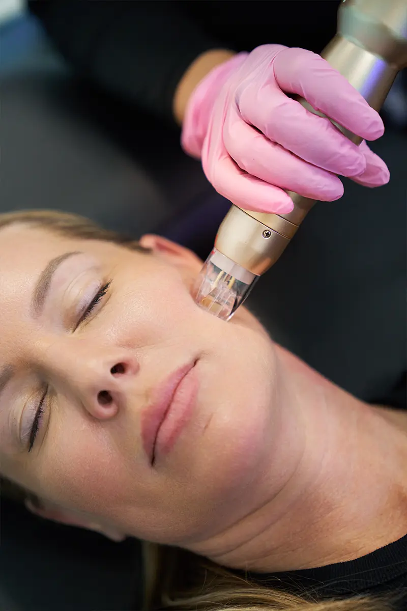Middle-aged woman receiving RF microneedling treatment on her upper mandible area at HTB