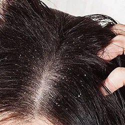 Dandruff on scalp