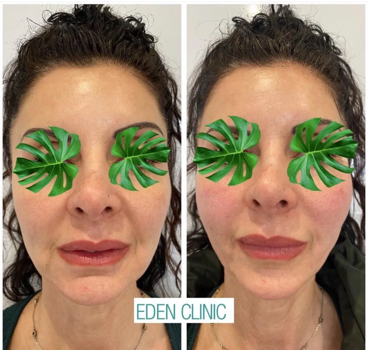 Two photographs of the same woman's face at Eden Clinic, leaves placed over her eyes for privacy