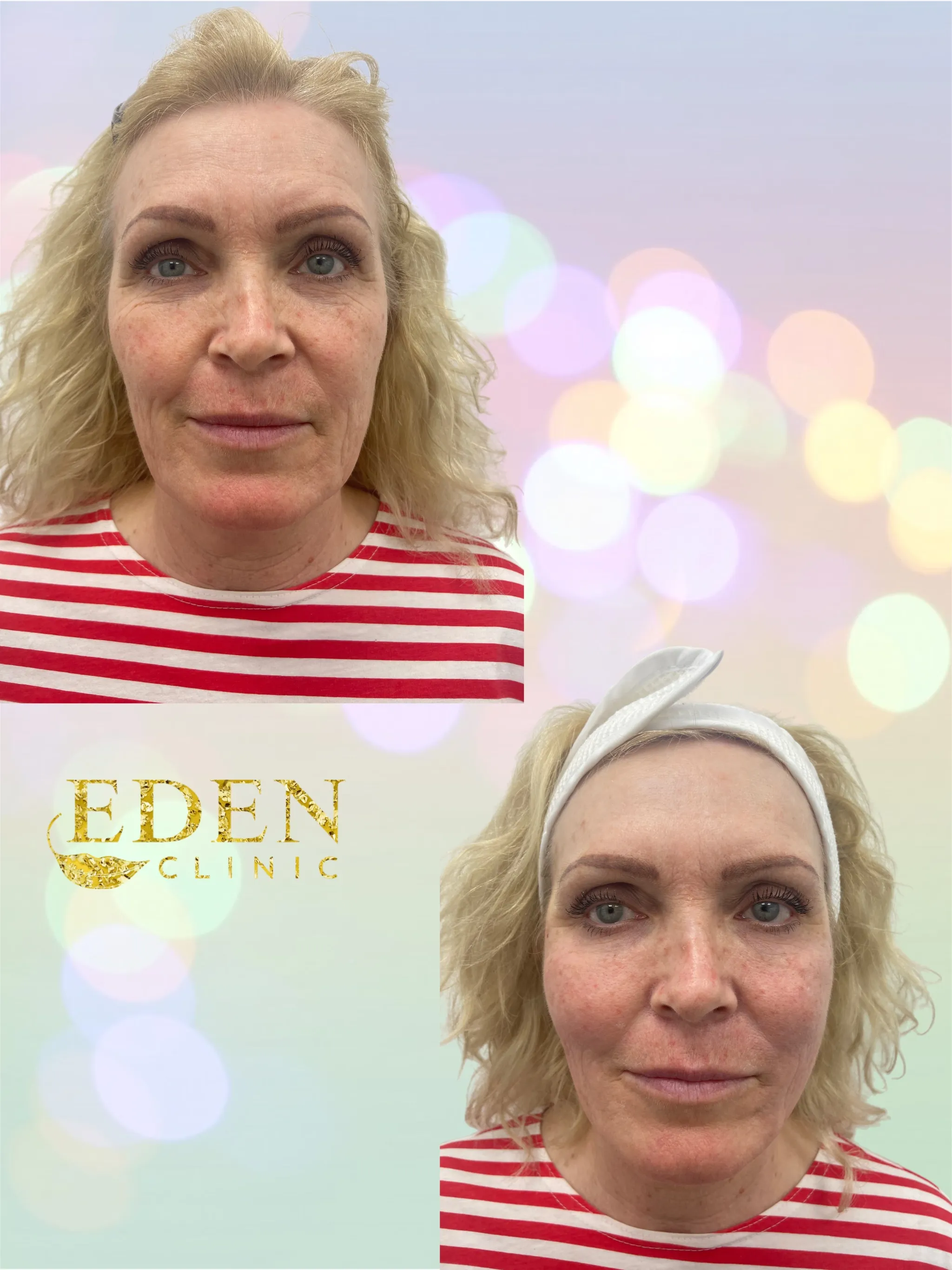 Two photographs of the same woman taken before and after a thread lift at Eden Clinic