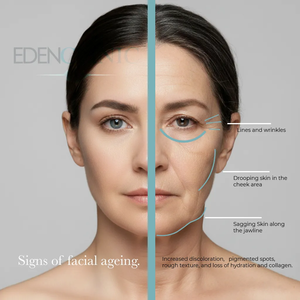 A woman's face marked with lines and labels showing where volume and skin quality change with age