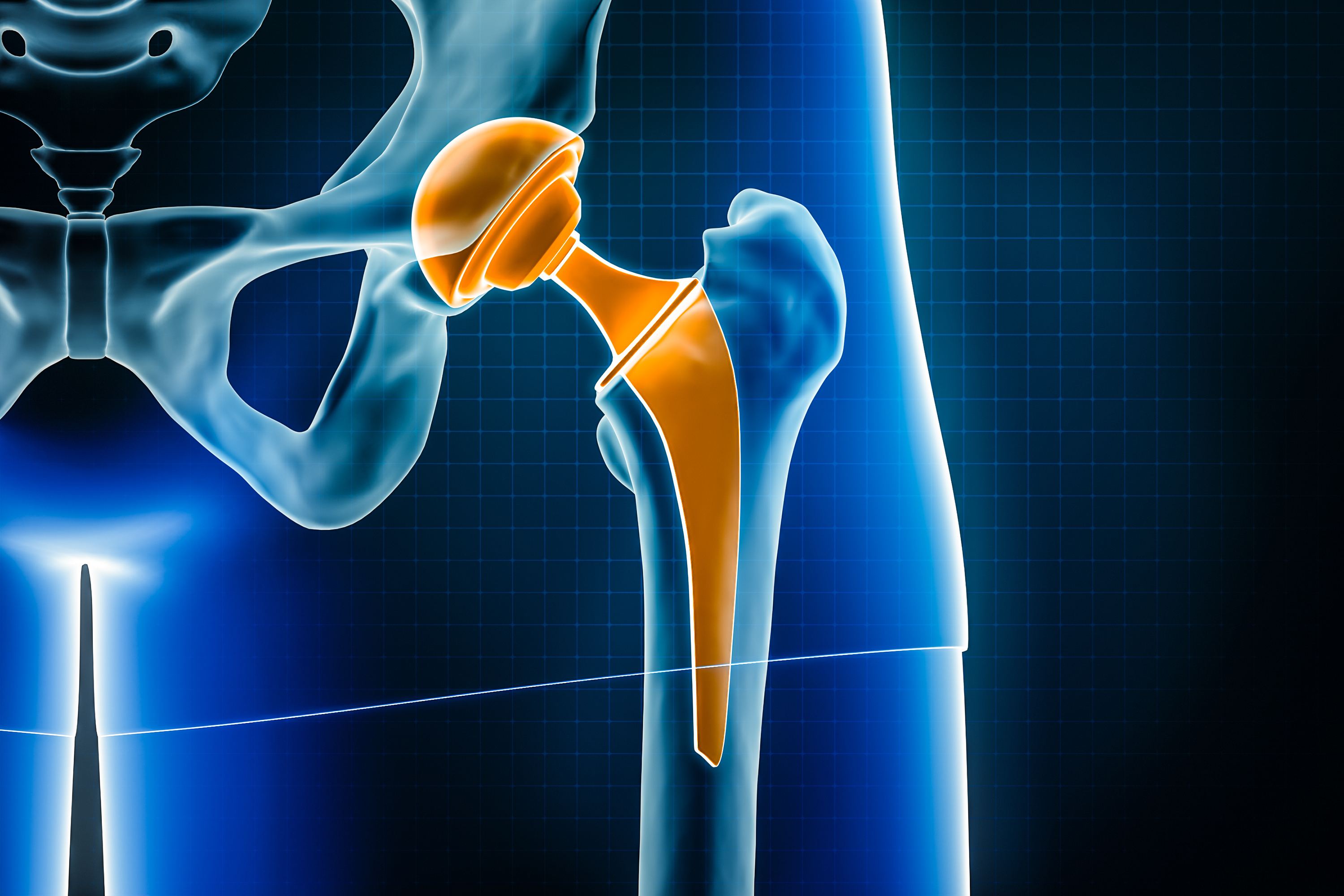 Künstlicher Hüftgelenkersatz (Hüft-TEP) und Hüftarthroskopie – Diagnose und Therapie bei Hüftarthrose und Synovitis im Orthopädicum Wien, Hüftspezialist in Wien.