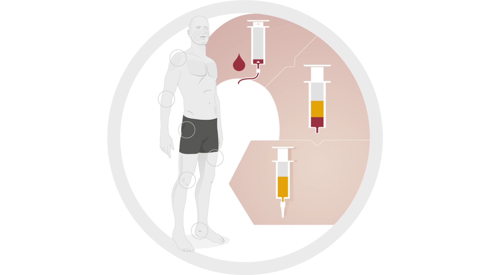 ACP-Therapie Wien – Eigenblutbehandlung zur Schmerzlinderung bei Gelenkbeschwerden und zur Förderung der Heilung im Orthopädicum Wien.