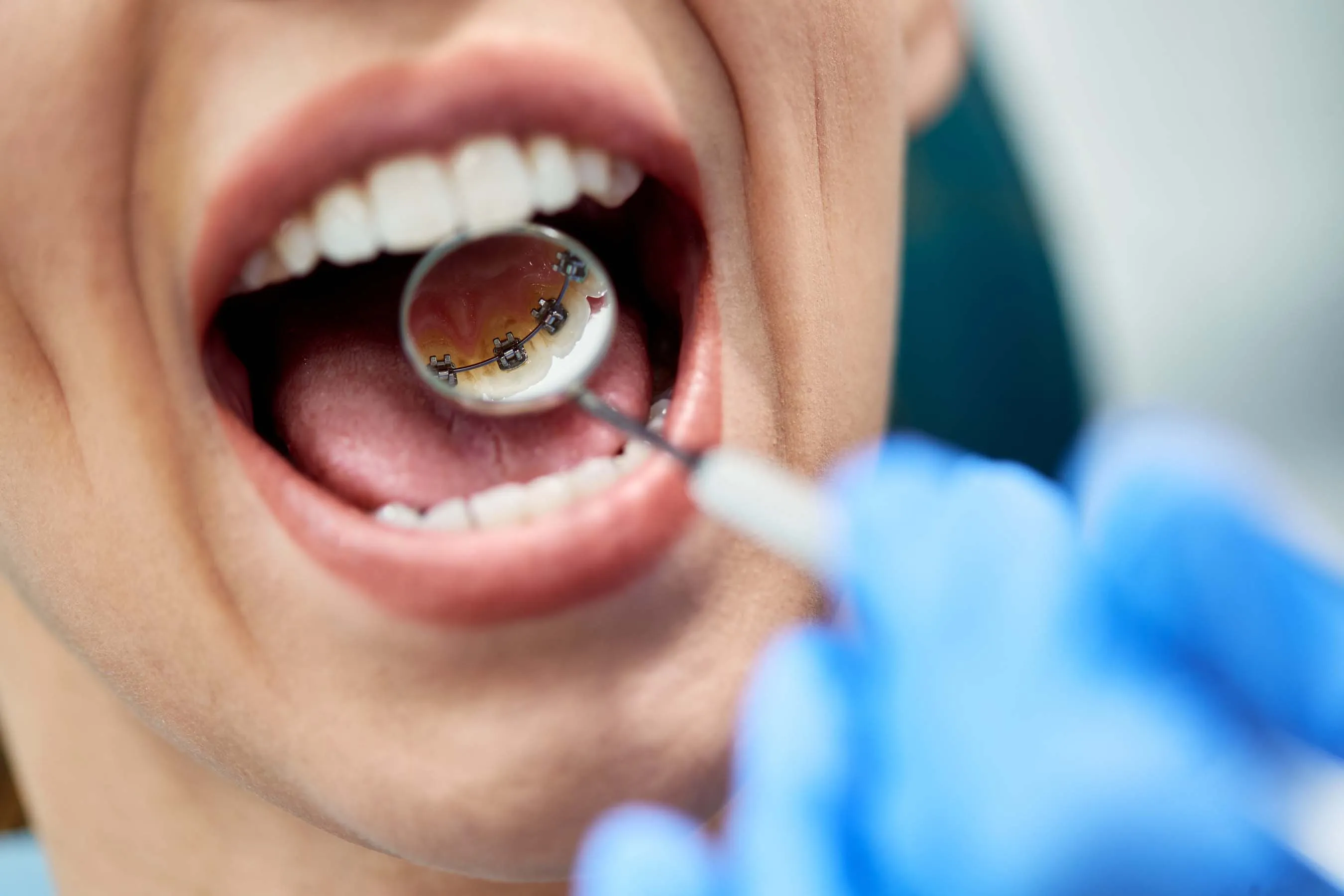 Why It’s Important to Have Good Dental Hygiene When You Have Braces
