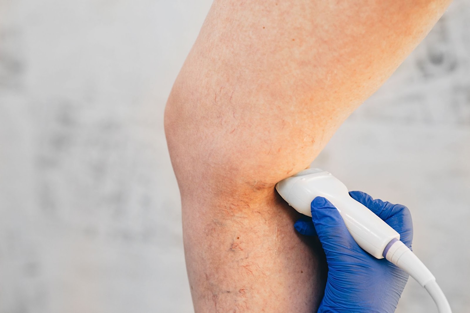 ultrasound vein evaluation on patient's leg at vein treatment center