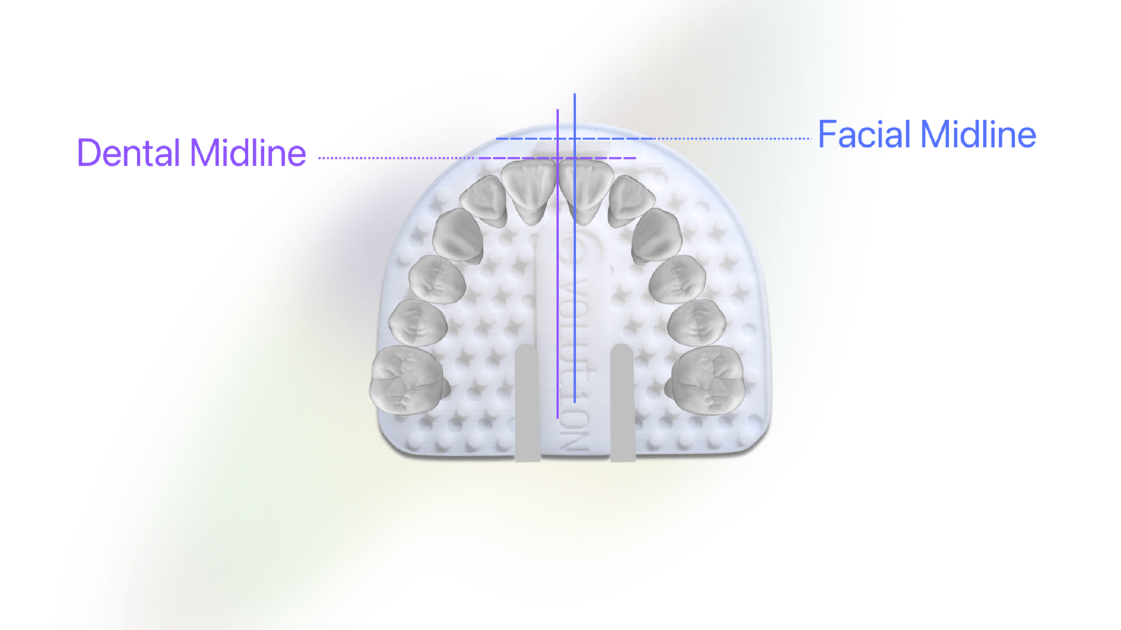 Dental and Midline References: Capturing the facial and dental midlines enables accurate assessment and case building by providing reliable reference points for comparison.