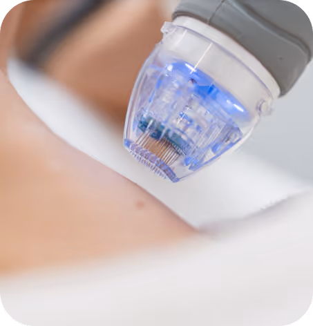 Close-up of a microneedling device with blue light being applied to skin.