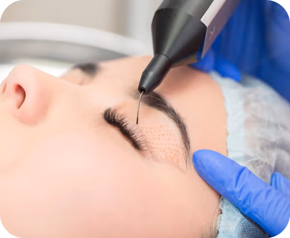 Close-up of a cosmetic plasma pen device performing eyelid skin treatment on a person's closed eye.