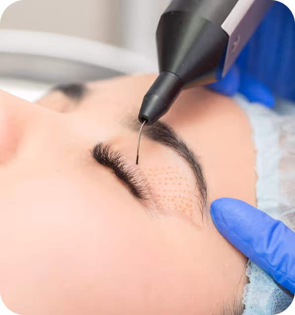 Close-up of a cosmetic procedure applying plasma fibroblast treatment on a woman's closed eyelid with dotted skin markings.
