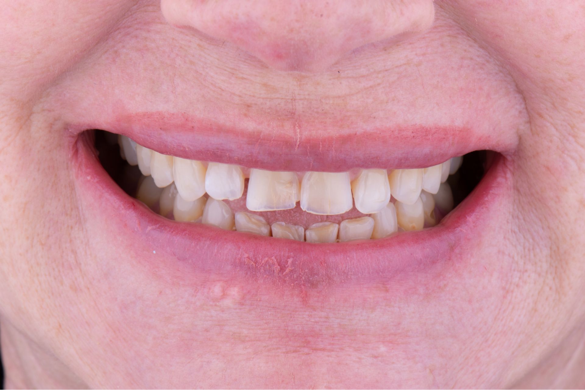 Close-up of a person's mouth showing uneven, discolored teeth with gaps.