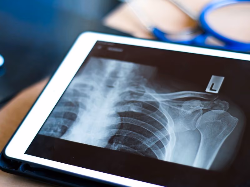 X-ray image of a left shoulder displayed on a digital tablet screen.