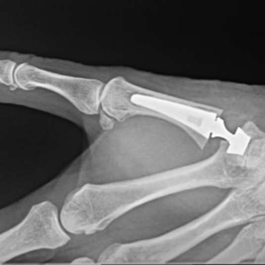 Base of Thumb Arthritis: What Are the Treatments 