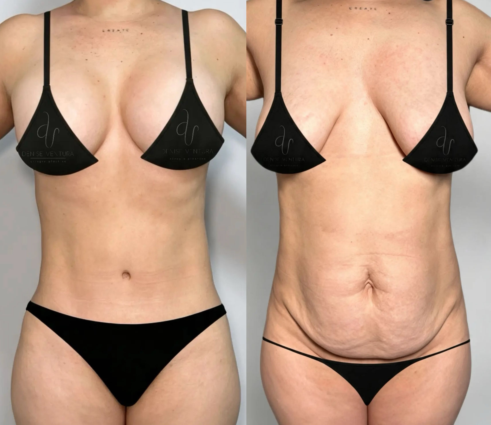 Antes y despues Mommy Makover en Bogota