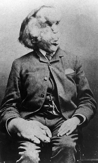 YourRoots Map_Surname_Famous People_Joseph Merrick