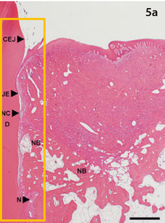 With HA, appropriate periodontal anatomy is restored.