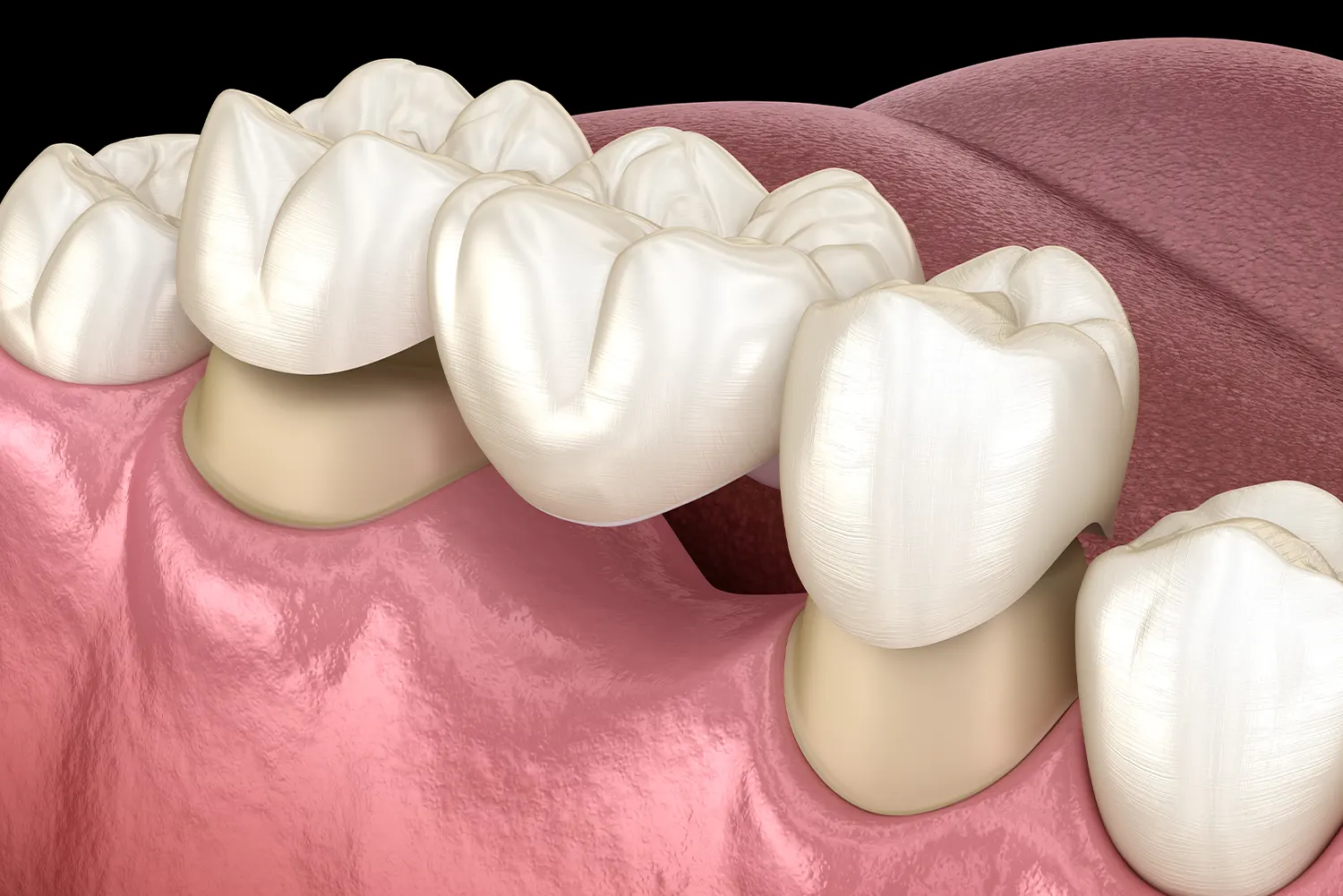 Dental Bridges in Eugene | Sheldon Park Dental