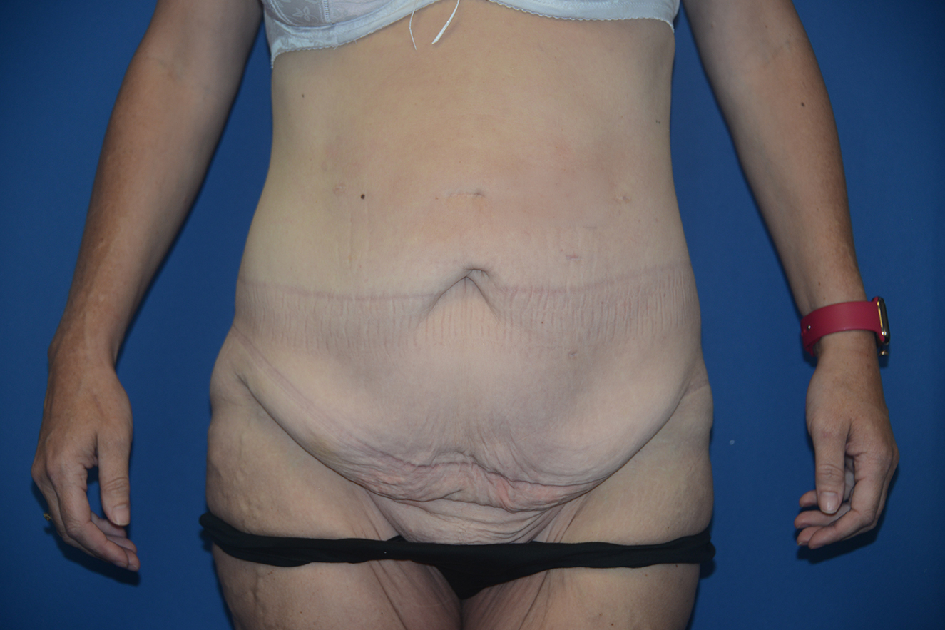 Radical Abdominal Lipectomy