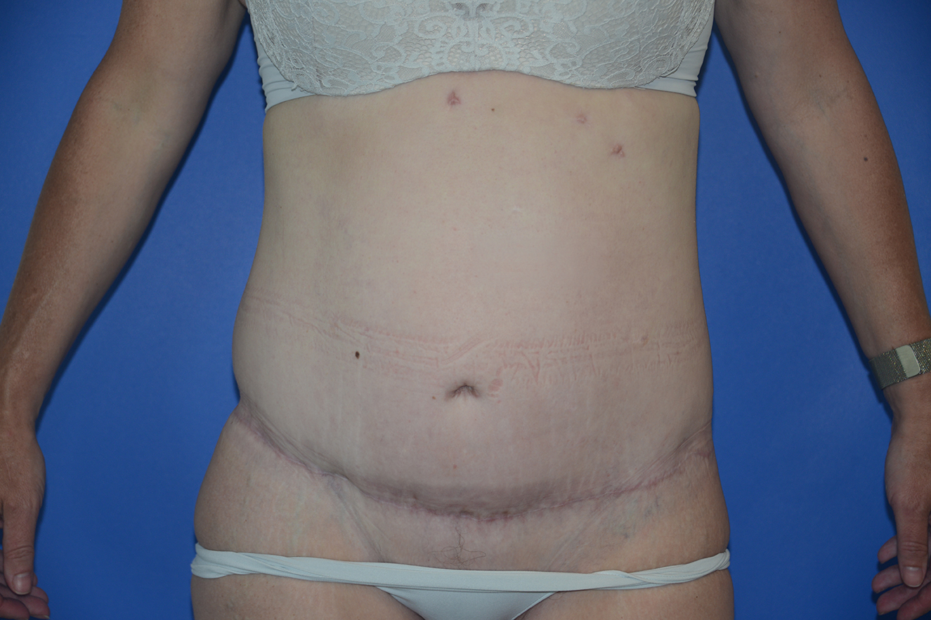 Radical Abdominal Lipectomy