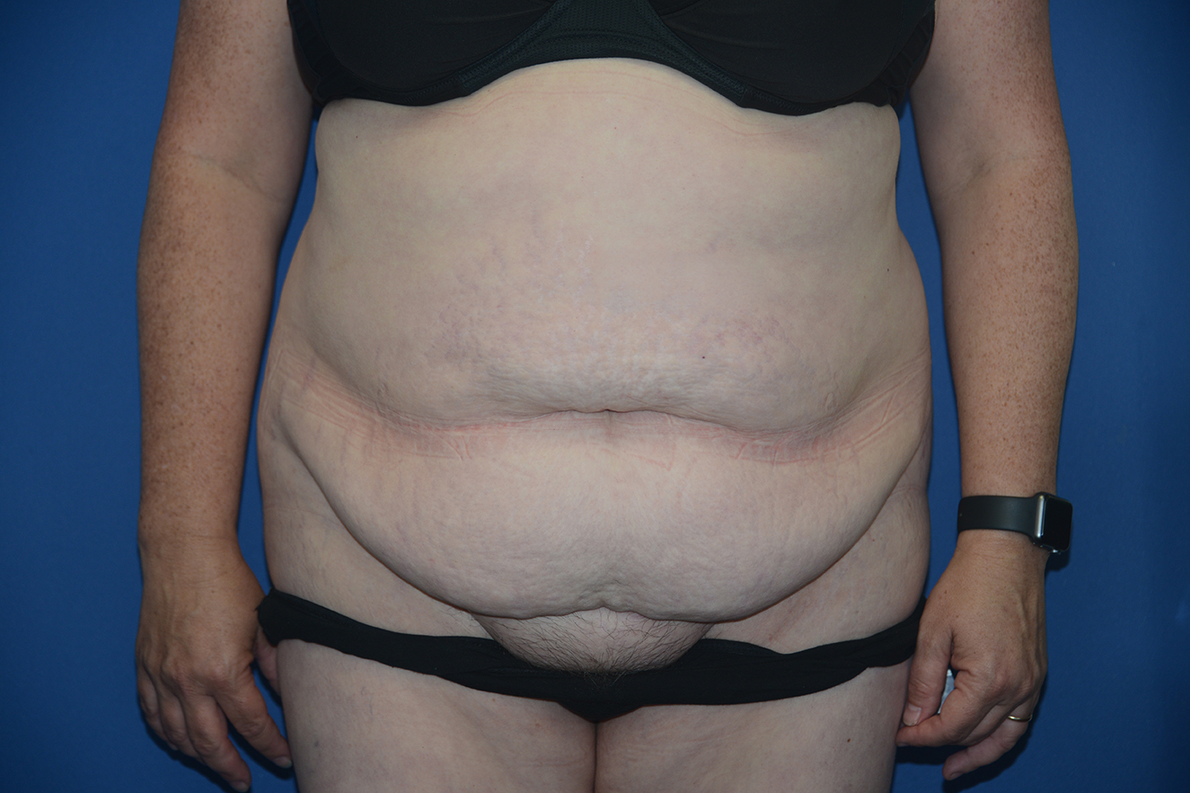Abdominoplasty Case 33
