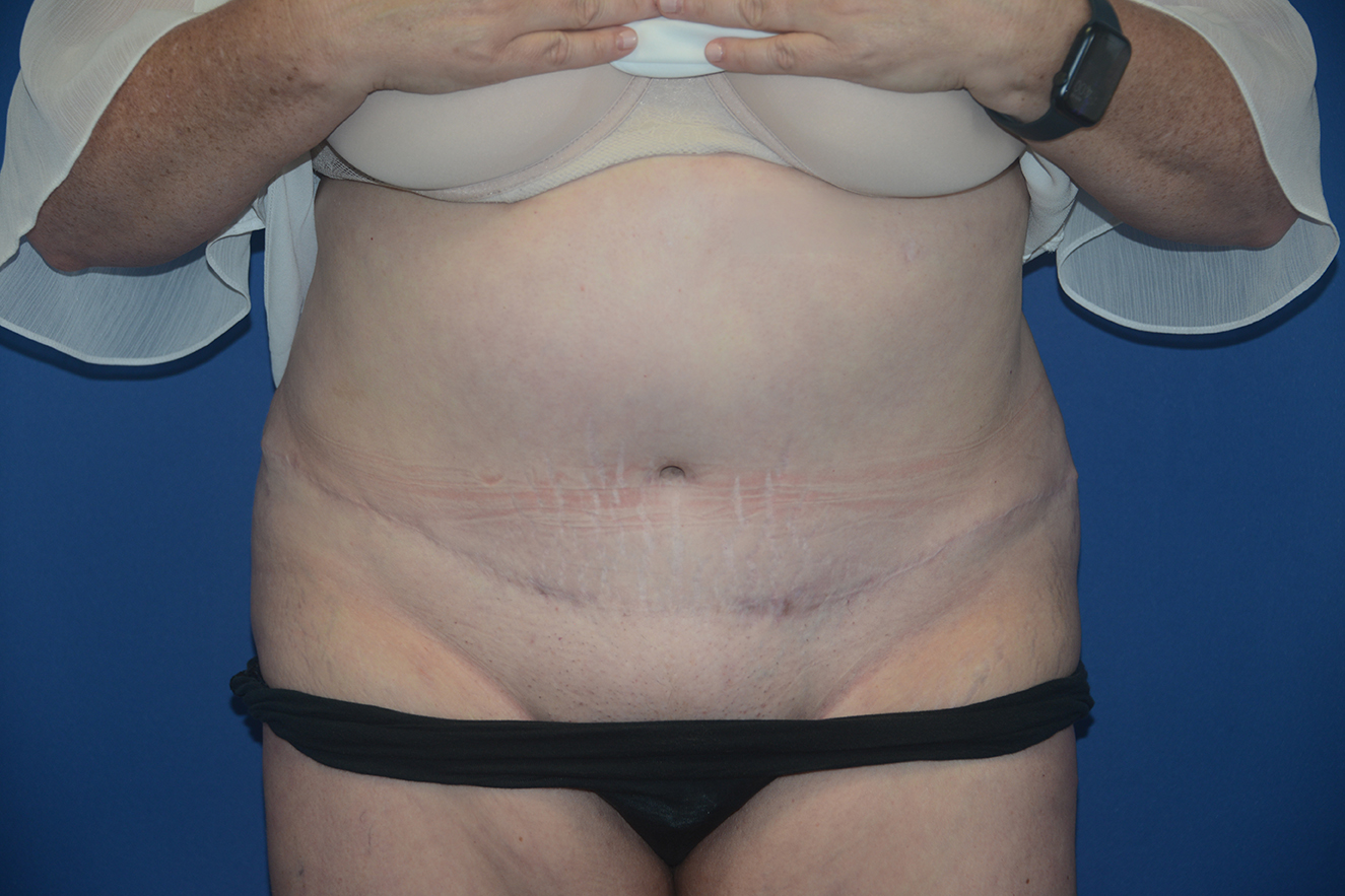Abdominoplasty Case 33