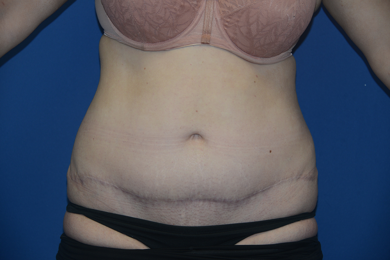 Abdominoplasty Case 34